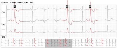 Therapeutic difficulties in a patient with Ehlers-Danlos syndrome and numerous symptomatic premature ventricular contractions—case report and literature review